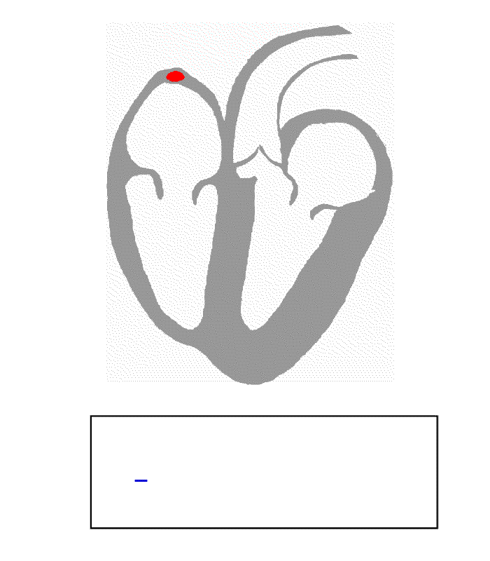 Animação mostrando o percurso do sinal elétrico feito pelo nódulo sinoatrial e do nódulo atrioventricular.